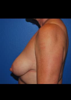 Breast Lift Patient # 6020