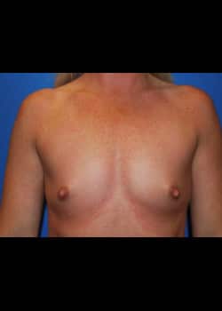 Breast Augmentation-Gel Patient #8020