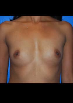 Breast Augmentation-Gel Patient # 8030