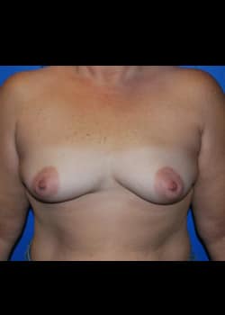 Breast Augmentation-Gel Patient # 8040
