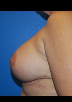 Breast Augmentation-Gel Patient # 8040