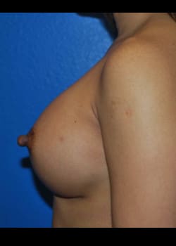 Breast Augmentation-Gel Patient # 8050