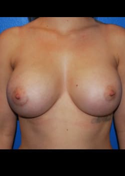 Breast Augmentation-Gel Patient # 8070
