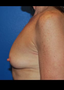 Breast Augmentation with Lift Patient # 3175