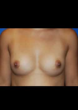 Breast Augmentation-Gel Patient # 8081