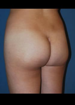 Buttock Implants Patient # 2510