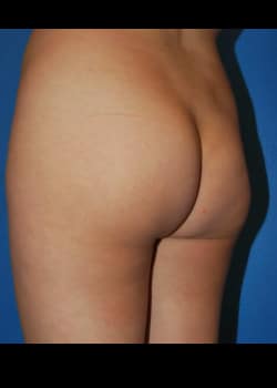 Buttock Implants Patient # 2510