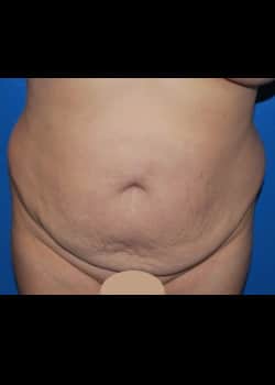 Tummy Tuck & Liposuction Patient #3400