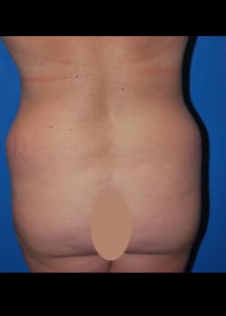 Tummy Tuck & Liposuction Patient #3400