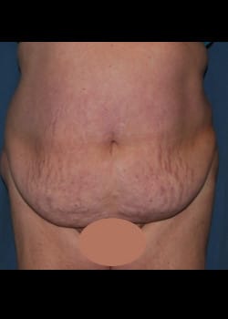 Tummy Tuck & Liposuction Patient # 3420