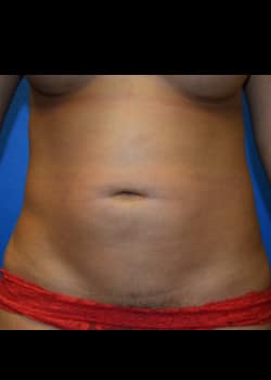 Liposuction Patient # 3430