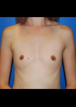 Breast Augmentation-Saline Patient # 3440