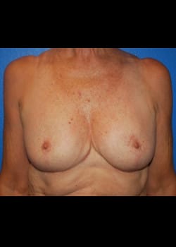 Breast Reduction Patient # 3447