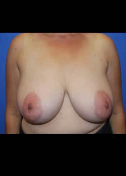 Breast Reduction Patient # 3454