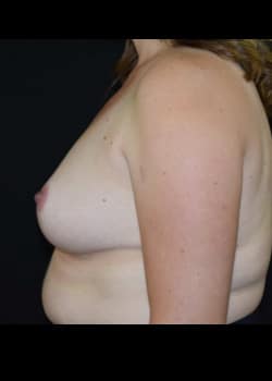 Breast Reduction Patient # 3454