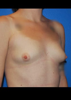 Breast Augmentation-Gel Patient # 3483