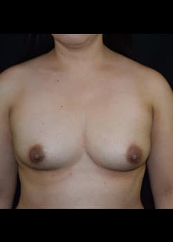 Breast Augmentation-Gel Patient # 3492