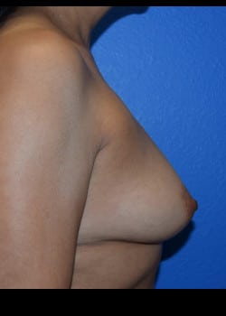 Breast Augmentation-Gel Patient # 3528