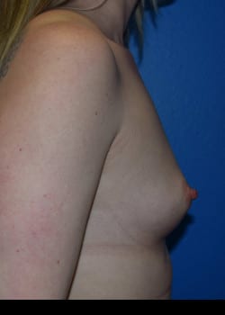 Breast Augmentation-Gel Patient # 3552