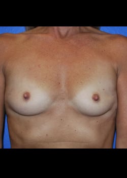 Breast Augmentation-Gel Patient # 3557