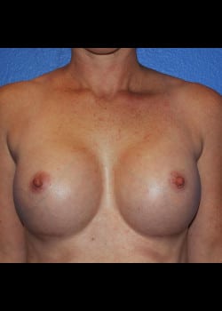 Breast Augmentation-Gel Patient # 3617