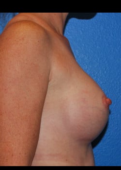 Breast Augmentation-Gel Patient # 3617