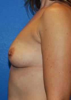 Breast Augmentation-Gel Patient # 3628