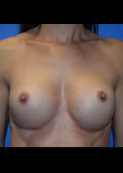 Breast Augmentation-Gel Patient # 3653