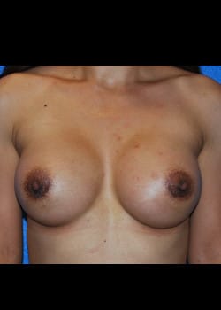 Breast Augmentation-Gel Patient # 3664