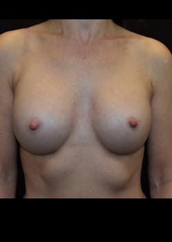 Breast Augmentation-Gel Patient # 3677
