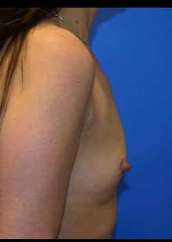 Breast Augmentation-Gel Patient # 3677