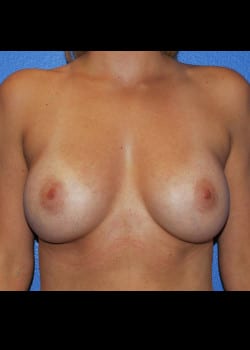 Breast Augmentation-Gel Patient # 3684