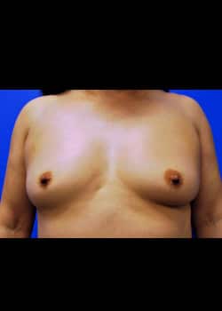Breast Augmentation-Gel Patient # 3696