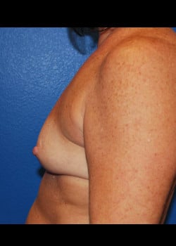 Breast Augmentation-Gel Patient # 3746