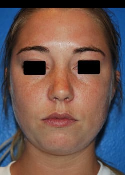 Nose Surgery Patient # 3782