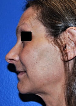 Nose Surgery Patient # 3862
