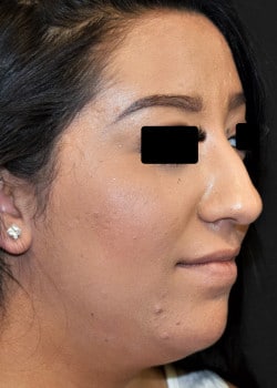 Nose Surgery Patient #3872