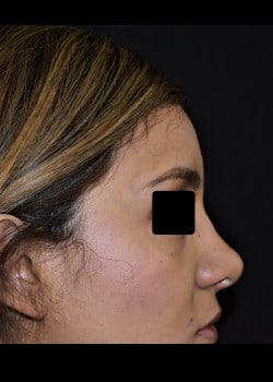 Nose Surgery Patient # 3954
