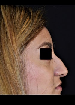 Nose Surgery Patient # 3954