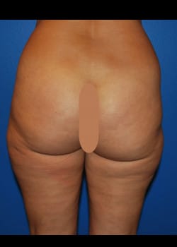 Thermitight with Liposculpture Patient #3965