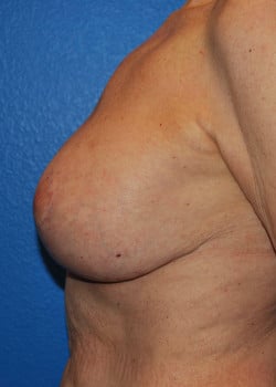 Breast Lift and Exchange to Smaller Implants Patient #3975