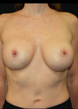 Breast Lift and Exchange to Larger Implants