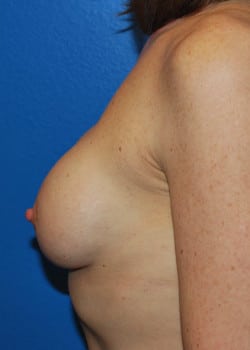 Breast Lift and Exchange to Larger Implants