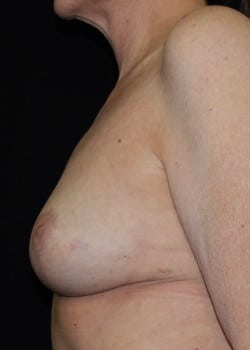 Breast Lift Patient # 4017