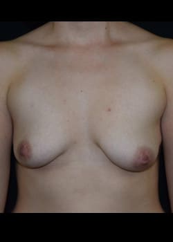Breast Augmentation With Lift Patient # 4029