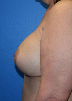 Breast Augmentation With Lift Patient # 4037