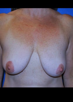 Breast Augmentation With Lift Patient # 4046