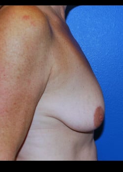 Breast Augmentation With Lift Patient # 4046