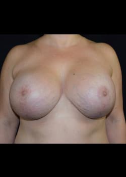 Breast Augmentation With Lift Patient # 4072