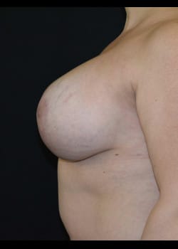 Breast Augmentation With Lift Patient # 4072